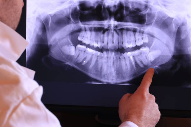 Best Knocked-Out Tooth (Avulsed Tooth) Treatment in Portland, IN