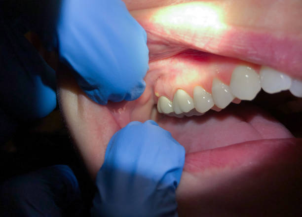 Best Emergency Root Canal Therapy in Portland, IN